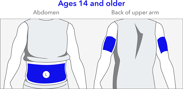 Choosing insertion site ages 14 and older