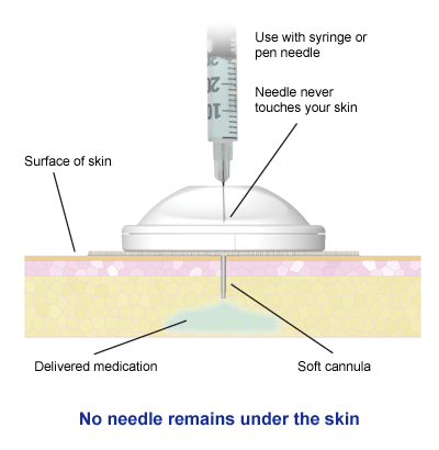 i-Port Advance | Injection Port | Inject Diabetes Medications | Fewer ...
