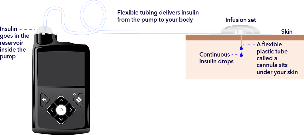 Insulin pump therapy adjustment